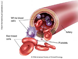 leucemia-2 Cronica