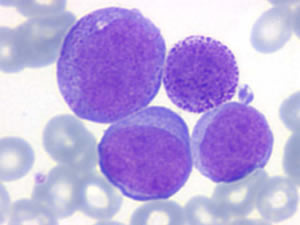 Leucemia Mielóide