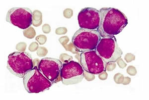 leucemia-3 Mieloide