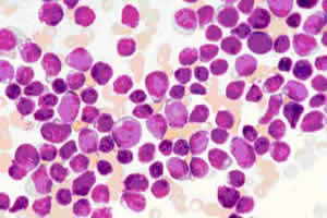 Leucemia Linfoblástica