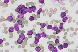 Leucemia Aguda