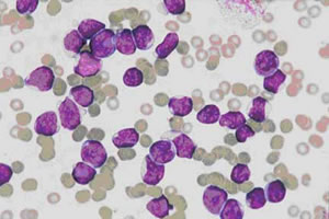 Leucemia Aguda Leucemia Aguda