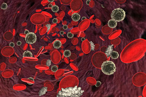 Leucemia Aguda Linfoblástica
