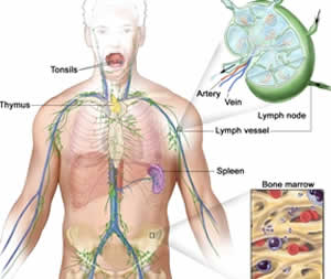 linfoma-3 Burkitt