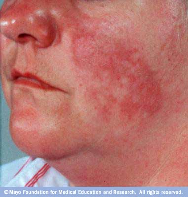 Lupus Lupus