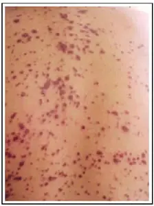 meningite-3 Meningite C