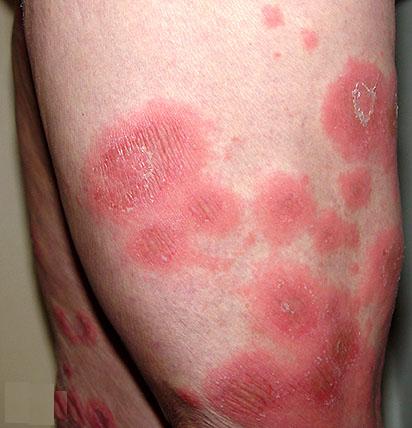 psoriase.jpg
