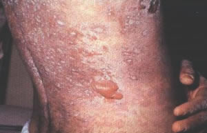 sindrome-1 Síndrome de Johnson