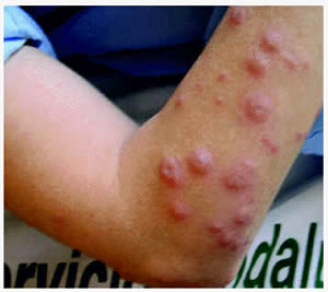 sindrome-2 Stevens