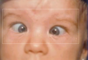 sindrome-2 Síndrome de Prader Willi