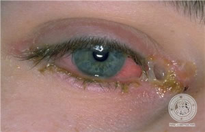 sindrome-3 Foto