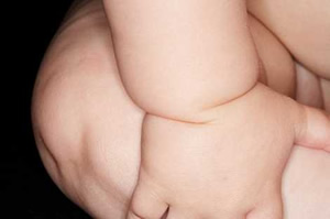 sindrome-3 Patau