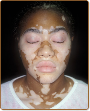 Vitiligo Vitiligo
