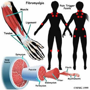 fibromialgia-1 Tratamento