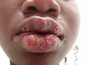 Herpes Genital Fotos