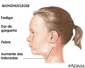 mononucleose-2 Mononucleose