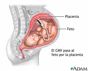 Citomegalovirus