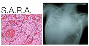 sindrome-1 Adulto