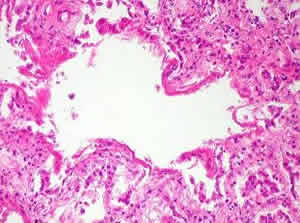 sindrome-2 Síndrome da Angustia Respiratória