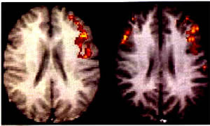 sindrome-2 Gilles