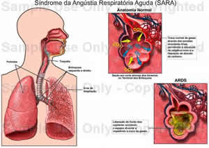 sindrome-3 Aguda