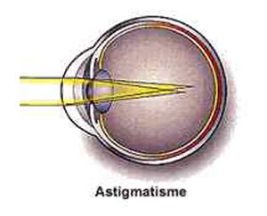 Astigmatismo