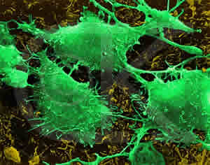 cancer-1 Câncer Um Inimigo Silencioso