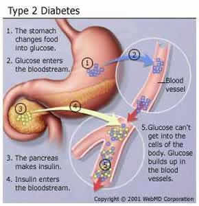 diabete-1 Tipo
