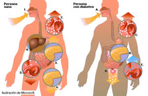 diabete-2 Tratamento