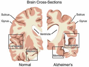 musicoterapia-1 Alzheimer