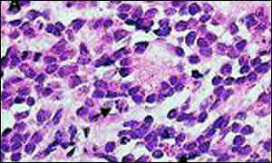 neuroblastoma-2 Câncer