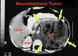 neuroblastoma-3 Tumor