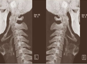 Síndrome de Eagle Radiografia
