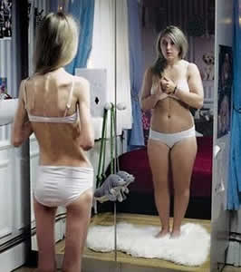 disturbio-alimentar-2 Anorexia