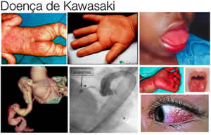 kawasaki-3 Síndrome de Kawasaki