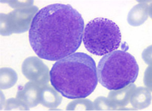 Leucemia Mieloblástica