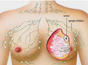 neoplasia-1 Maligno