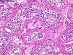 neoplasia-2 Neoplasia