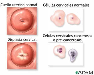 neoplasia-3 Cervical