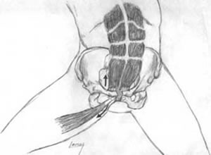 Pubalgia Pubalgia