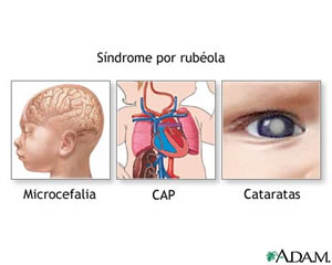 rubeola-3 Sindrome