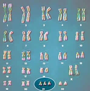 sindrome-de-patau-3 Trissomia