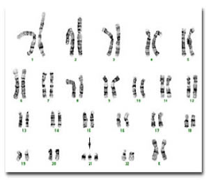 sindrome-edwards-1 Trissomia