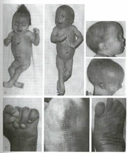 sindrome-edwards-3 Tratamento