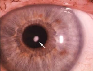 sol-nos-olhos-2 Doença