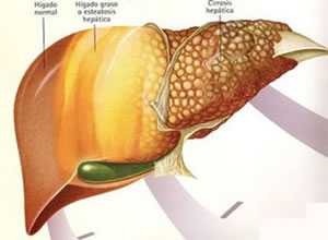 Síndrome Hepatorrenal