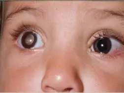 Câncer de Olho em Crianças