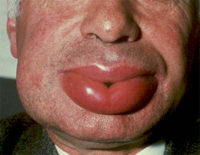alergia angioedema