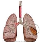 Pneumonia Infantil