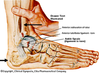 Artrose no tornozelo
